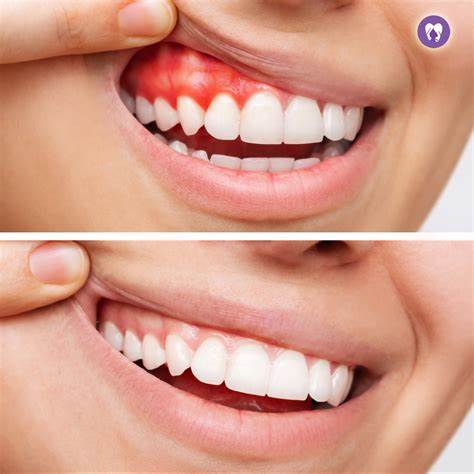 Scaling and root planing
