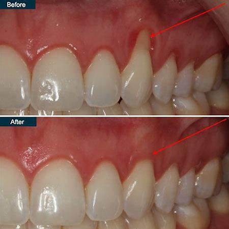 Periodontal maintenance visit