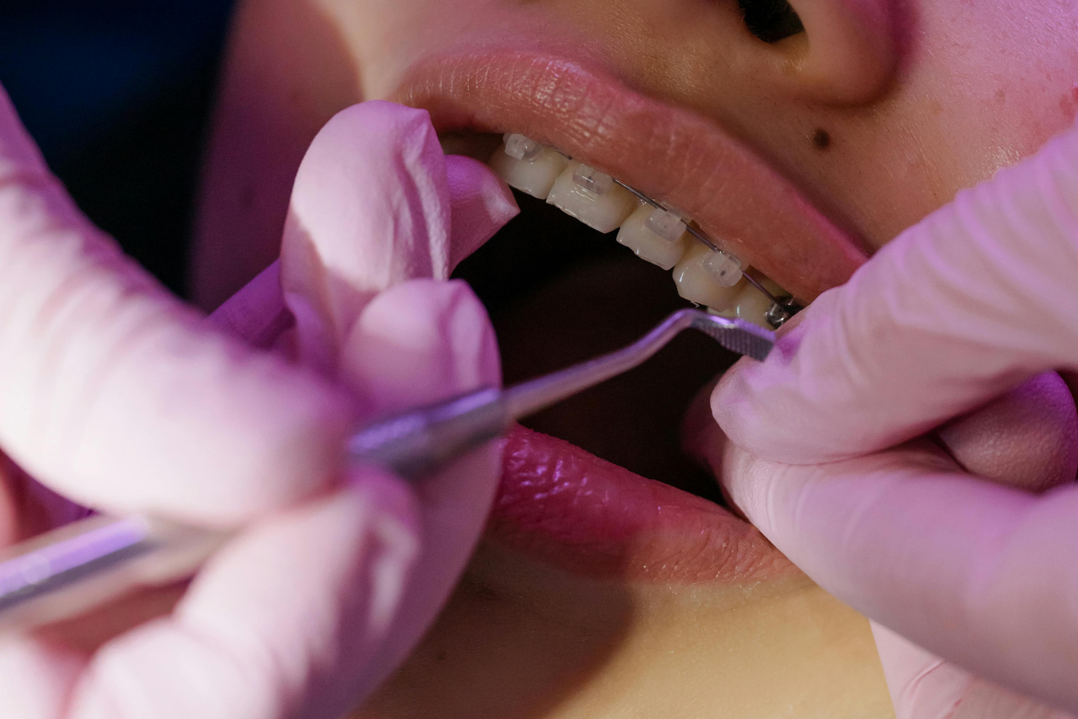 Tooth-colored fillings and crowns
